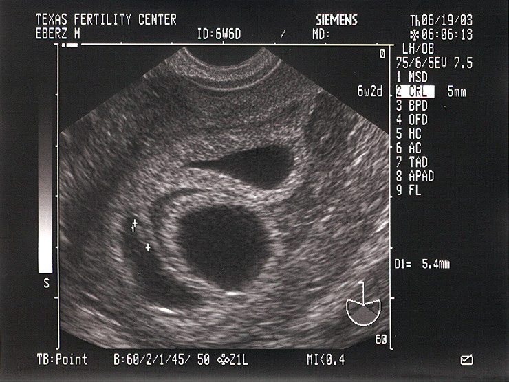 Mojo's Fetus 3